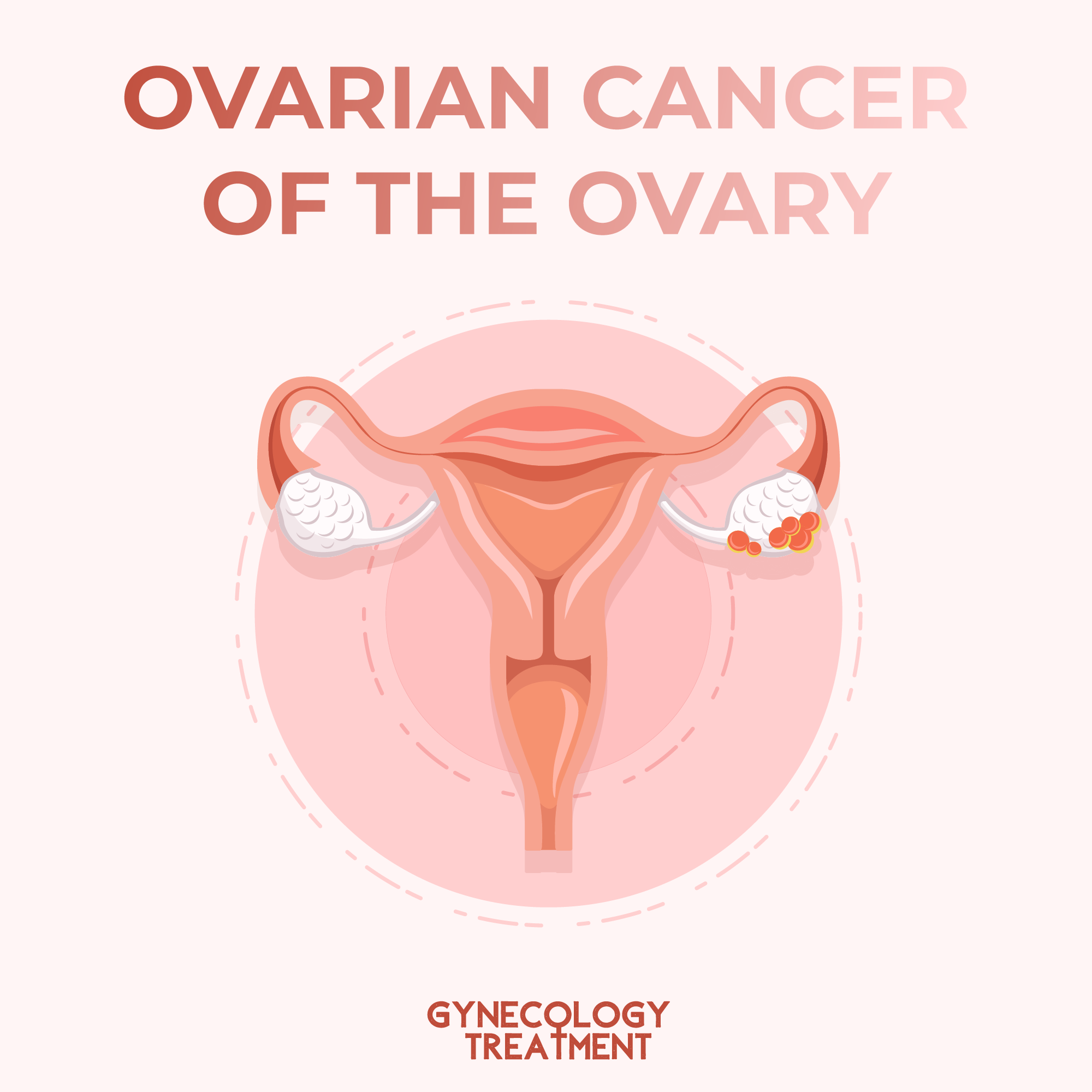 Ovarian Cancer of the Ovary