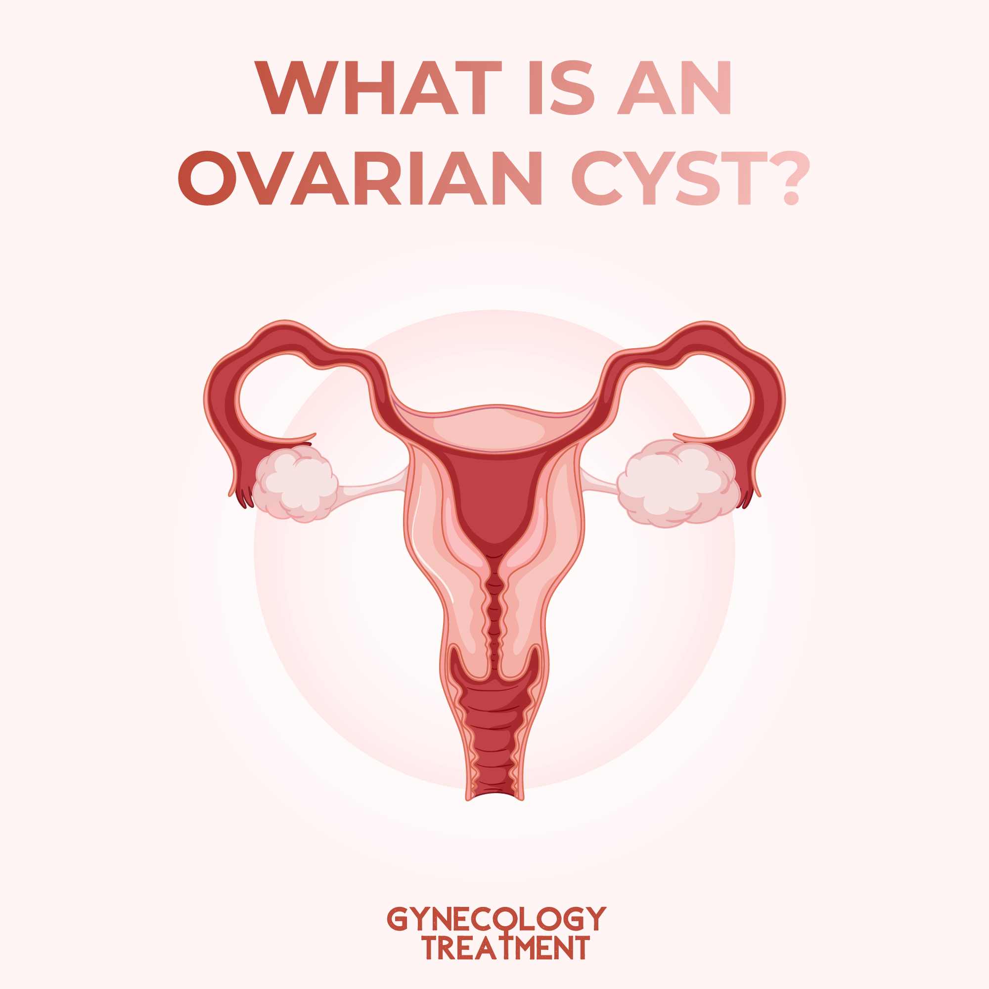 WHAT IS AN OVARIAN CYST?